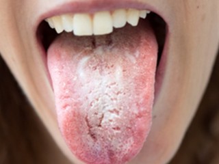 Pamukçuk Belirtileri Nelerdir? - Detaylı Rehber