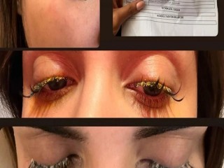 Esenyurt'ta Güzellik Salonunda Gözüne Yapıştırıcı Kaçtı, Kısmi Kör Oldu!